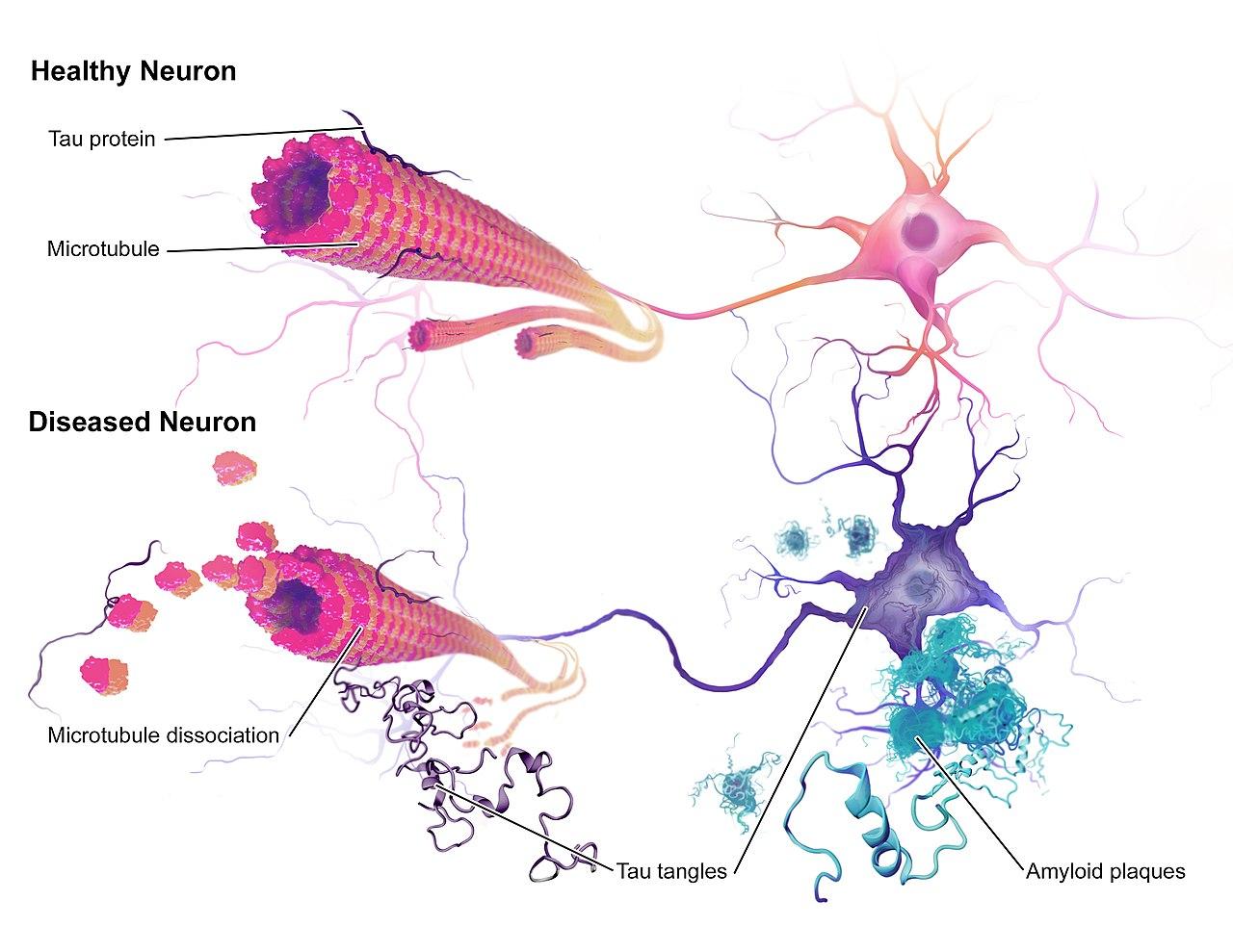 An illustration of the neuropathology of Alzheimer's disease - BruceBlaus / CC BY-SA